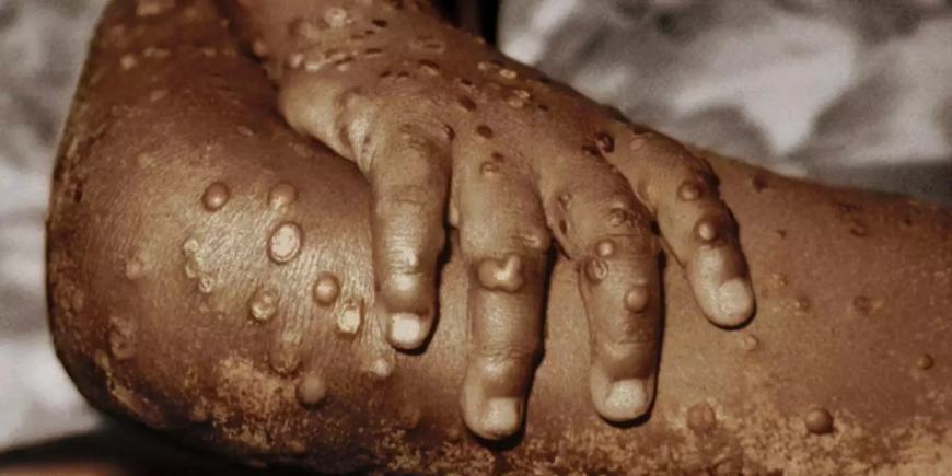 First Monkeypox death in South Africa puts Mozambique on high alert